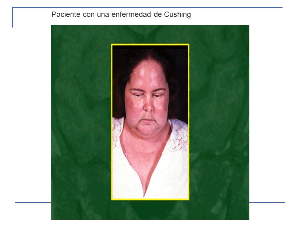 La terapia láser en el tratamiento del acné